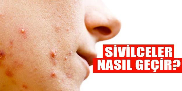 Sivilceye ne iyi gelir? Sivilce lekeleri nasıl geçer?