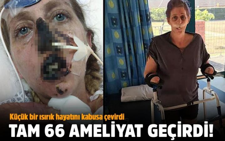 Hayatını kabusa çevirdi! 66 ameliyat geçirdi