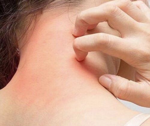 Son Dönemin Hastalığı “Uyuz”