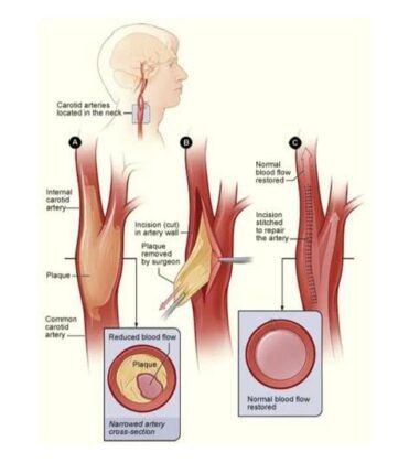 İnme Hakkında Bilinmeyenler Nelerdir ?