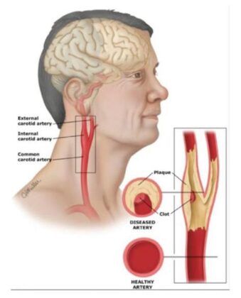 İnme Hakkında Bilinmeyenler Nelerdir ?