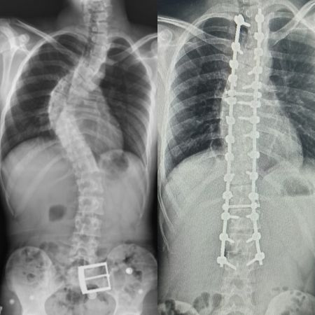 Tokat’tan gelen skolyoz hastası Samsun’da şifa buldu