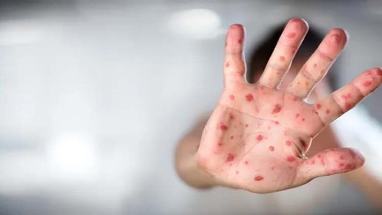 Maymun çiçeği virüsü kaç ülkede görüldü, toplam vaka sayısı ne kadar? DSÖ Son Dakika Maymun Çiçeği hastalığı