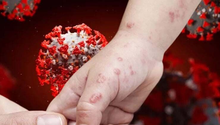 Arjantin’de de maymun virüsü ortaya çıktı