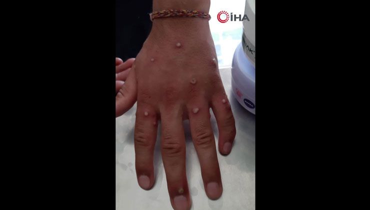 Sultangazi’de ‘Maymun Çiçeği’ şüphesi: Test sonucu bekleniyor