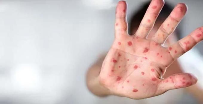 En fazla maymun çiçeği vakasının görüldüğü ülke belli oldu