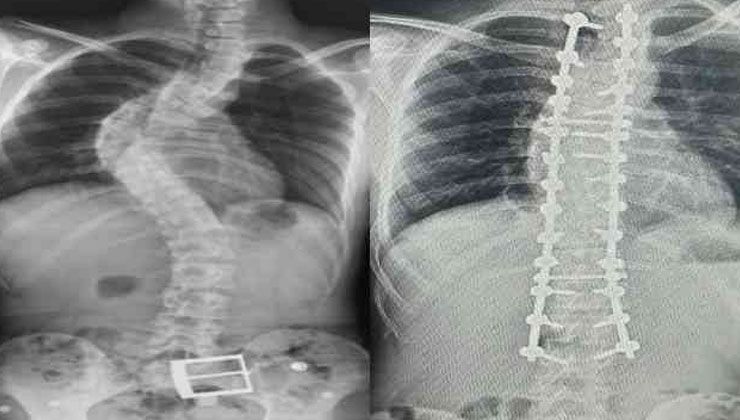 Skolyoz nedir? Skolyozun tedavisi var mı? Skolyoz nasıl geçer