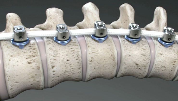 Skolyoz nedir? Skolyozun tedavisi var mı? Skolyoz nasıl geçer