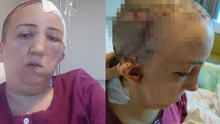 Kafatası kemiği kaybolmuştu, ameliyatla yenisi takıldı