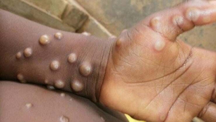 Bayram öncesi uzmanından ‘maymun çiçeği’ uyarısı