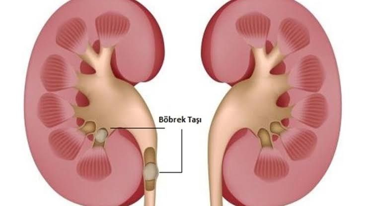 Her gün tükettiğimiz o besin meğer böbrek taşına neden oluyormuş!