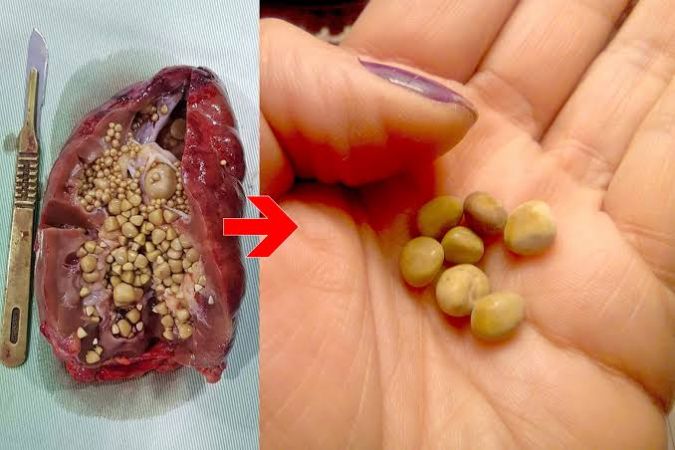 Her gün tükettiğimiz o besin meğer böbrek taşına neden oluyormuş!