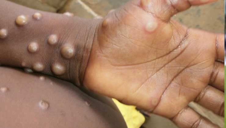 DSÖ, Maymun Çiçeği hastalığını küresel acil durum ilan etti