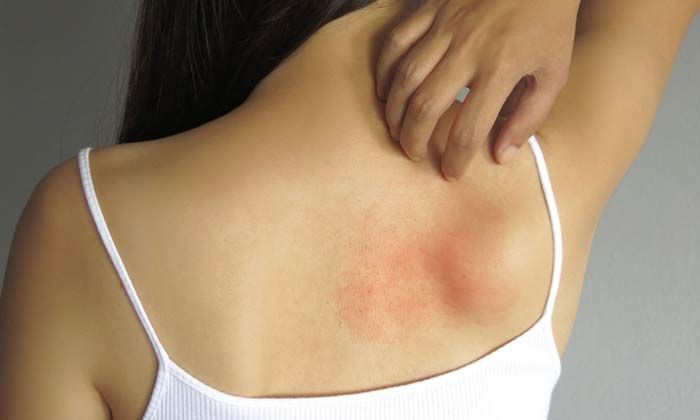 Alerjinizi iyi tanıyın