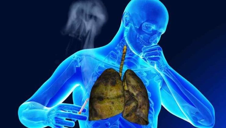 KOAH’ta yeni dönem: Rezektör balon tedavisi