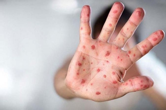 Maymun çiçeği virüsü 92 ülkede görüldü: Dünya genelindeki vaka sayısı 35 bini aştı