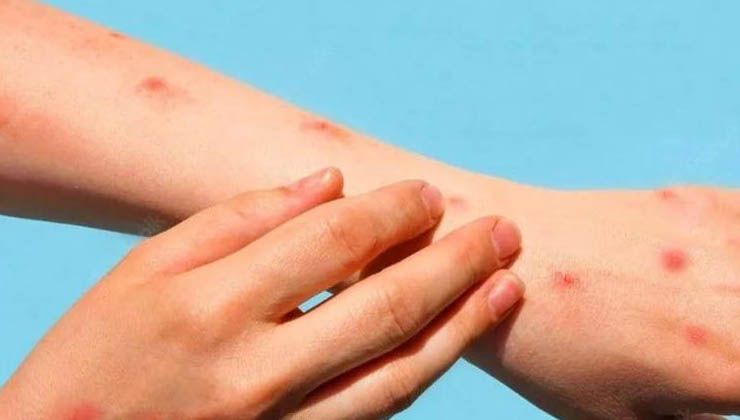 Çocukları tehdit eden domates gribi yetişkinlerde de görülebilir