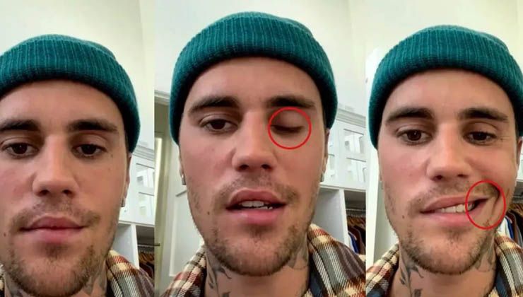 Justin Bieber yüz felci geçirmişti! Ünlü yıldız hastalığından sonra ilk defa görüntülendi