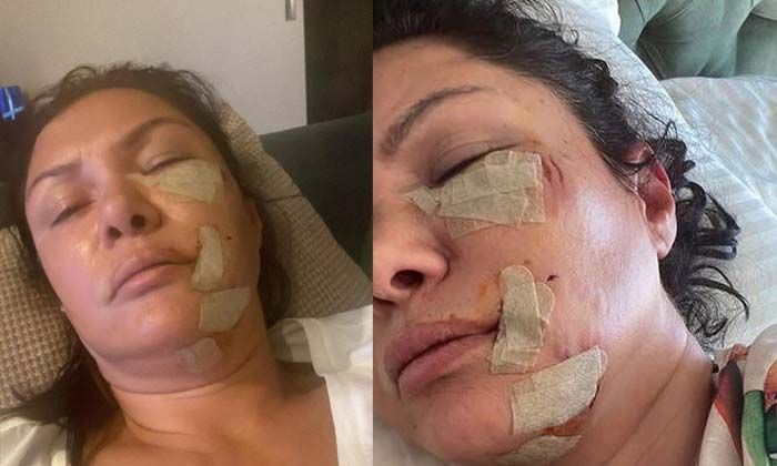 Ünlü şarkıcı Tuğba Altıntop köpek saldırısına uğradı