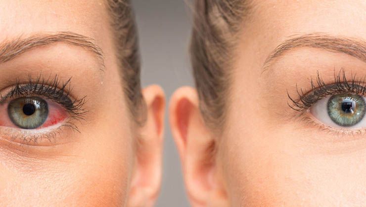 “Göz kuruluğunun altından mite çıkabilir”