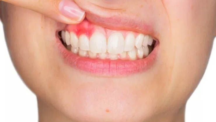 Diş eti rahatsızlığı olanlar dikkat! 4 büyük hastalığın habercisi olabilir