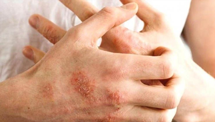 Sonbaharda alerjik egzamaya dikkat