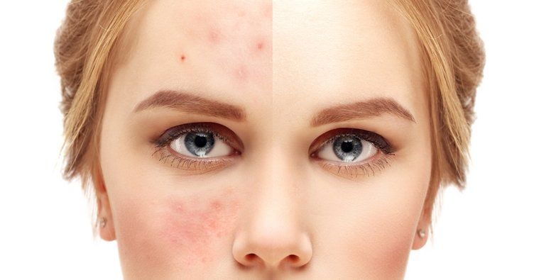 Kurtulduğunuz aknelerin bir daha ortaya çıkabilir