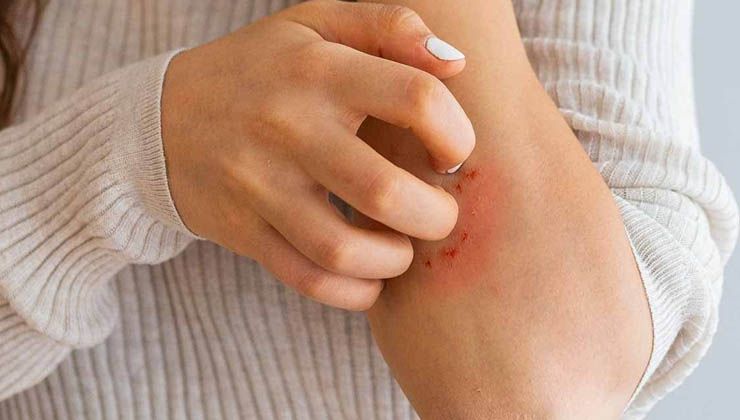 Dermatoloji uzmanından kaşıntı uyarısı