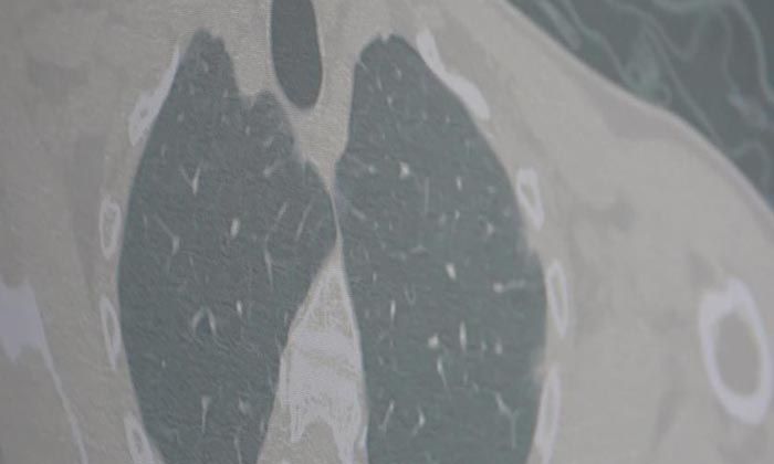 Covid-19’da yeni hasta profili: “Kronik grip”