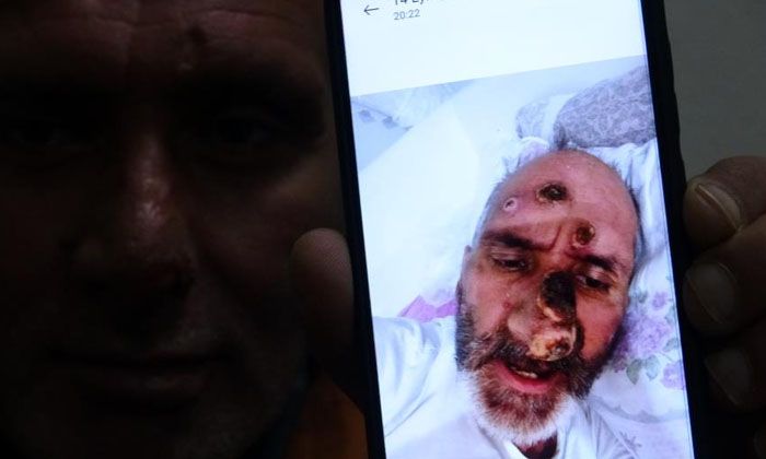 Afrika’dan gelen sineğin, Antalya’da ısırdığı kişinin hayatı karardı