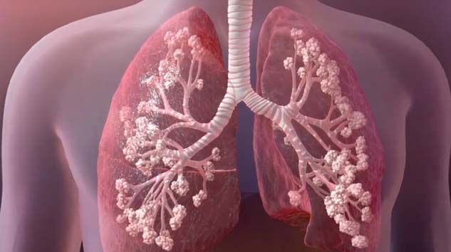 Koronavirüs sürecinde kistik fibrozis hastaları büyük risk altında