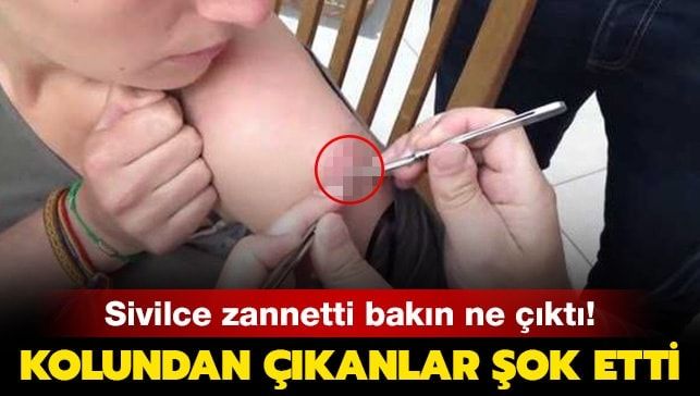 Genç kadının kolundan çıkanlar şoke etti!