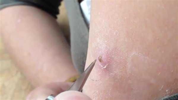 Genç kadının kolundan çıkanlar şoke etti!