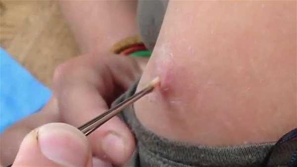 Genç kadının kolundan çıkanlar şoke etti!