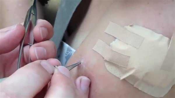 Genç kadının kolundan çıkanlar şoke etti!