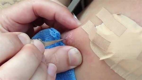 Genç kadının kolundan çıkanlar şoke etti!