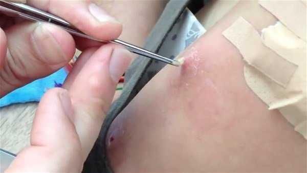 Genç kadının kolundan çıkanlar şoke etti!