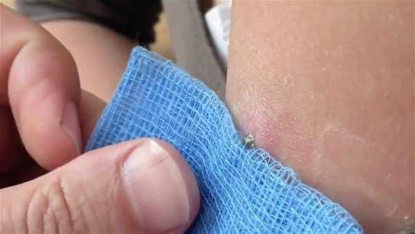 Genç kadının kolundan çıkanlar şoke etti!