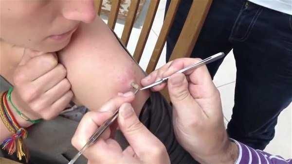 Genç kadının kolundan çıkanlar şoke etti!