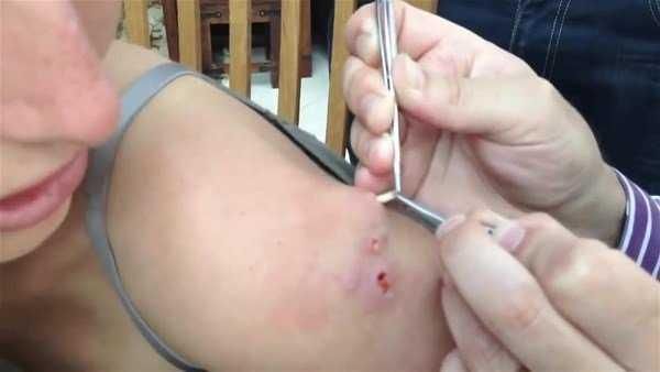 Genç kadının kolundan çıkanlar şoke etti!