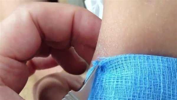 Genç kadının kolundan çıkanlar şoke etti!