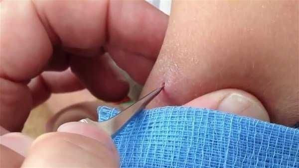 Genç kadının kolundan çıkanlar şoke etti!