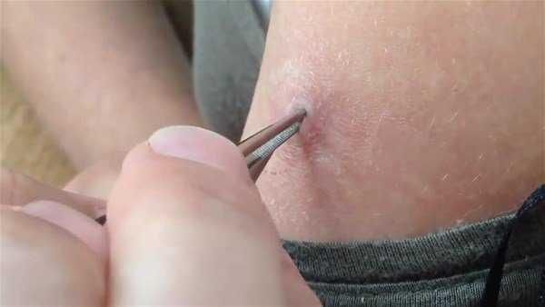 Genç kadının kolundan çıkanlar şoke etti!