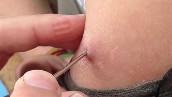 Genç kadının kolundan çıkanlar şoke etti!