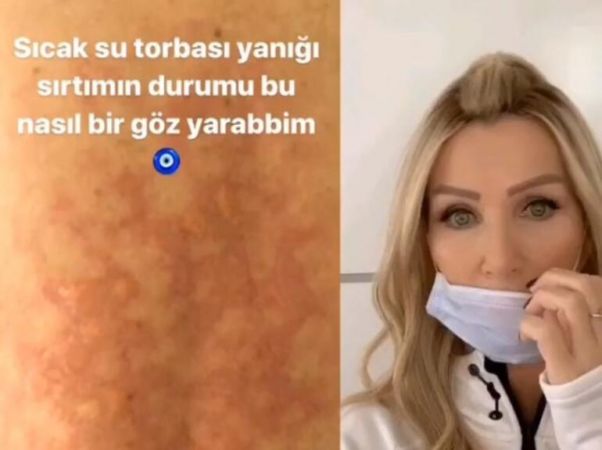 Sıcak su torbası patladı, Seda Sayan hastanelik oldu!