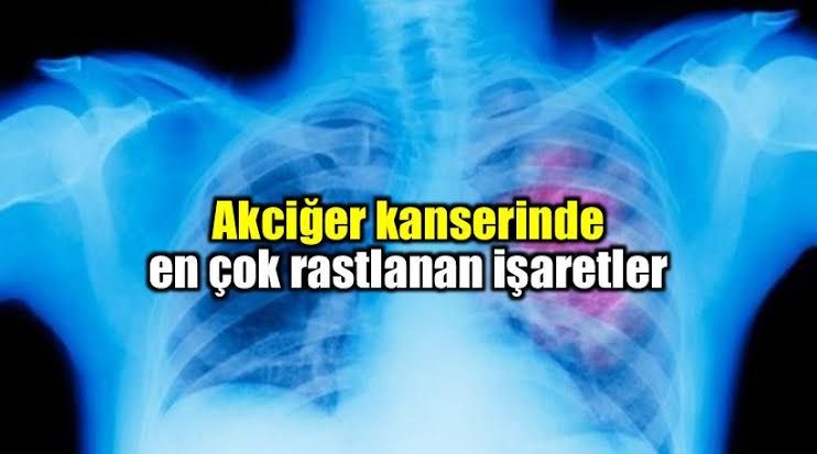 Akciğer Kanserinin 8 önemli İşareti
