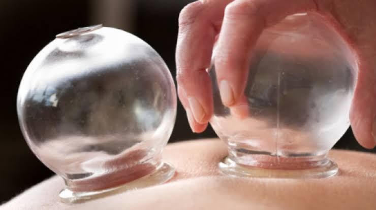 Hacamat Nedir? Hacamat Nasıl Yapılır