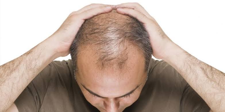 Müjde! Kelliğe Kökten Çözüm Getiren Bir İlaç Geliştirildi