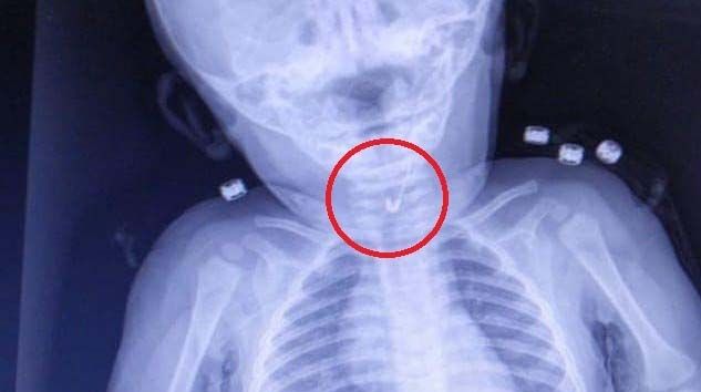 7 aylık bebeğin yemek borusundan çengelli iğne çıktı