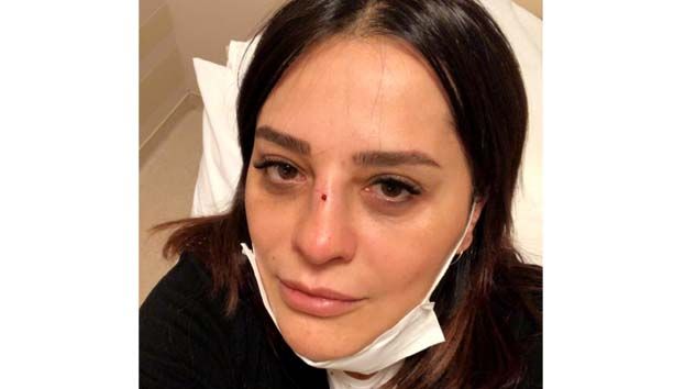 Burnu kırılan ünlü şarkıcı Reyhan Karaca hastaneye kaldırıldı